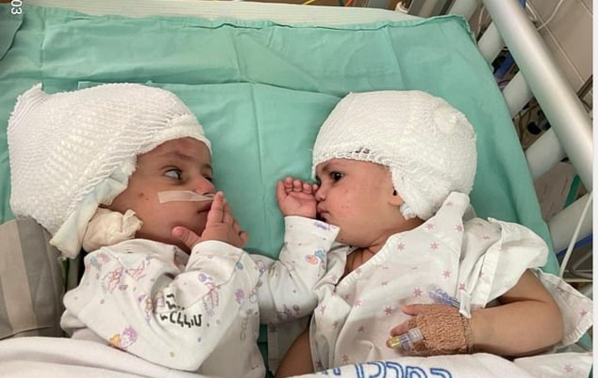 The Israeli craniopagus twins lying on a hospital bed post-operation.