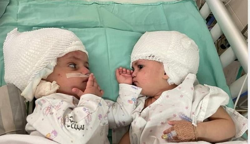 The Israeli craniopagus twins lying on a hospital bed post-operation.