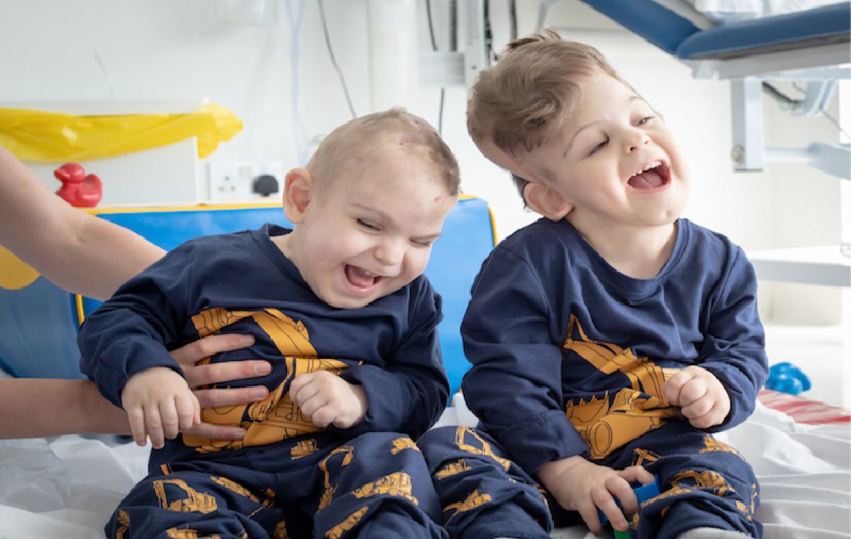 Yigit and Derman, two craniopagus twins, smile happily post-operation, they are in a hospital.