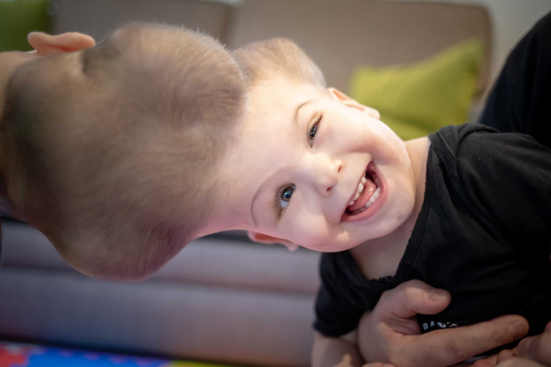 Yigit and Derman, two craniopagus twins. One of them smiles towards the camera. They are still attached at the skull.