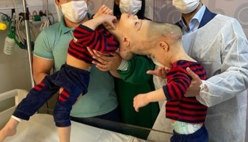 An image of Arthur and Bernardo, craniopagus twins, before their separation surgery. They are being held up by their parents and a doctor, and are on a hospital bed.