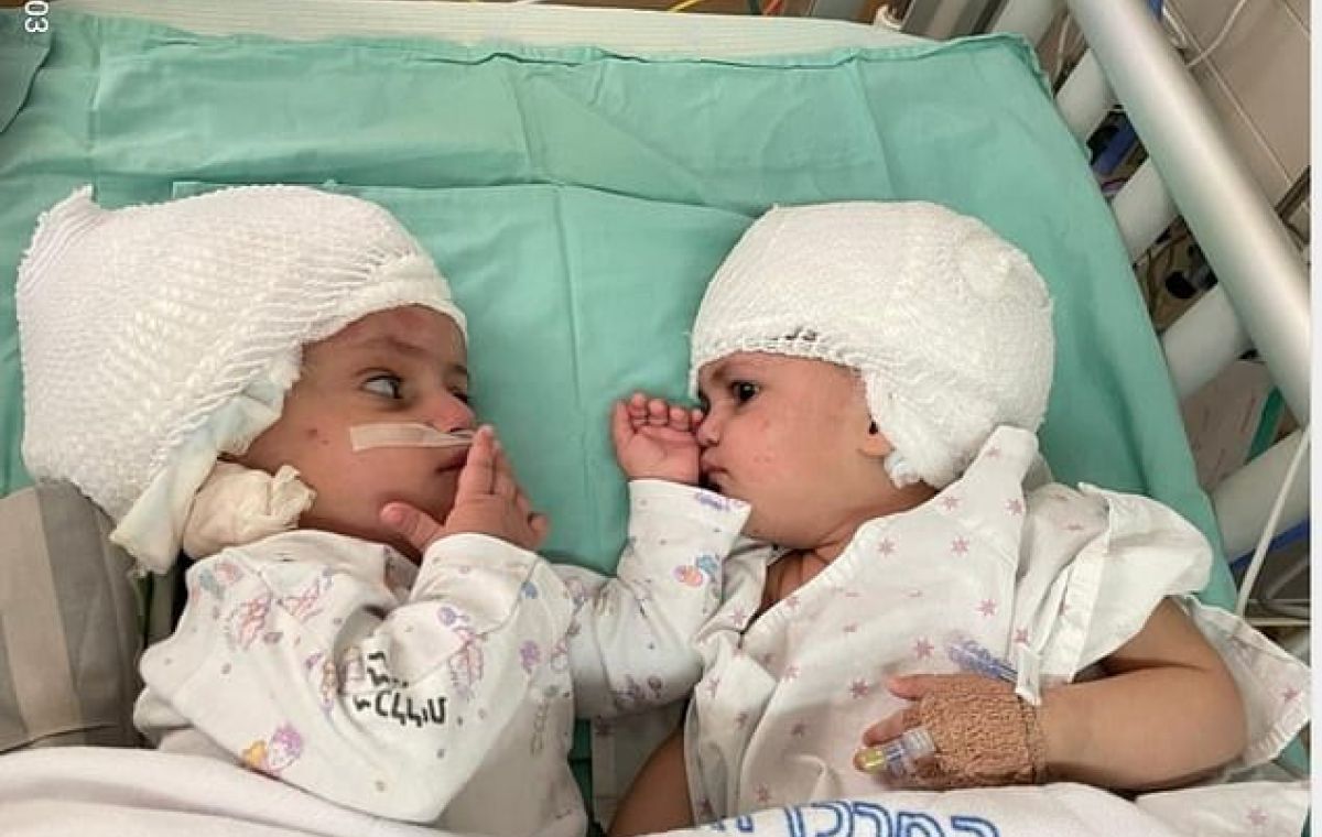 The Israeli craniopagus twins lying on a hospital bed post-operation.