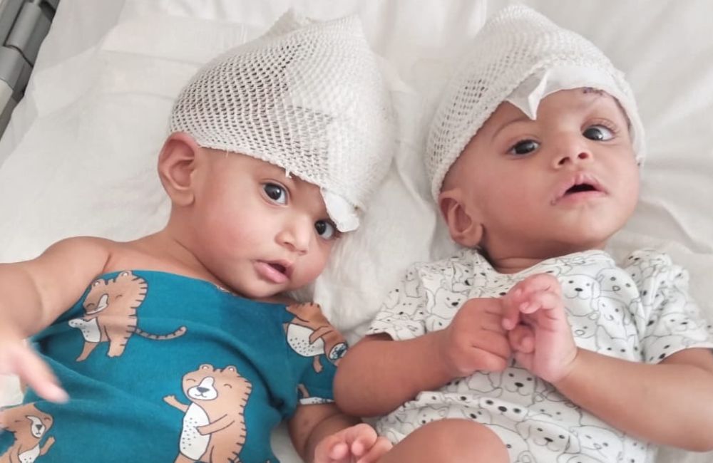 Two craniopagus twins lie on a carpet. One of them smiles at the camera.